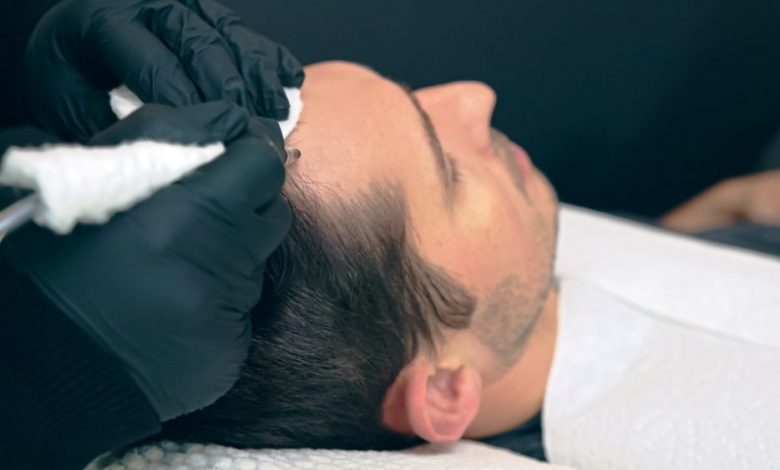 Scalp Micropigmentation