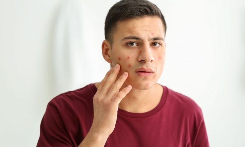 guy with acne