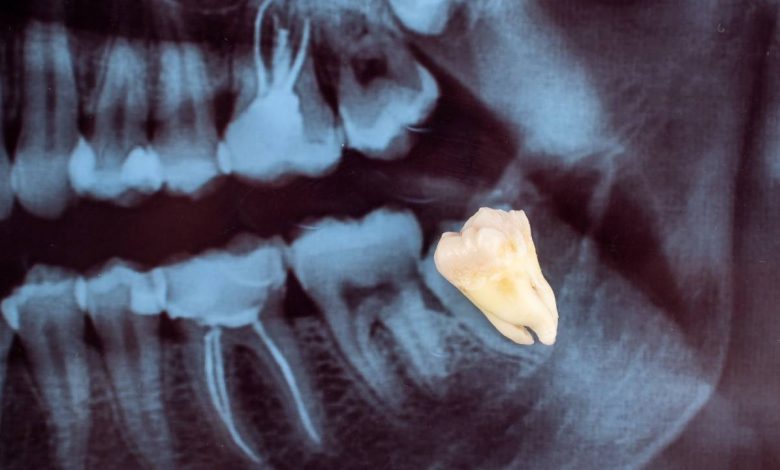 Wisdom Tooth