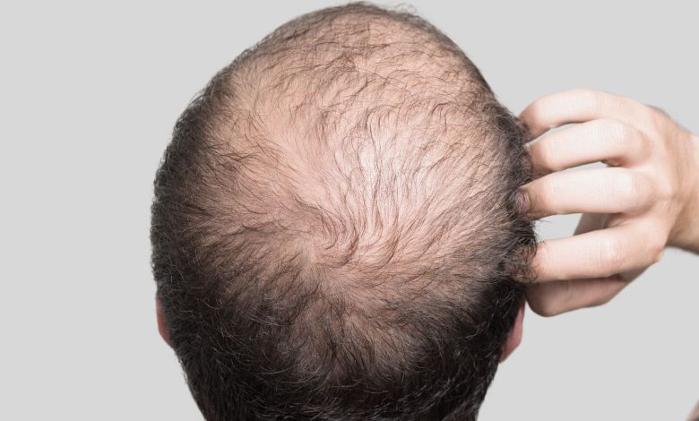 Male Pattern Baldness