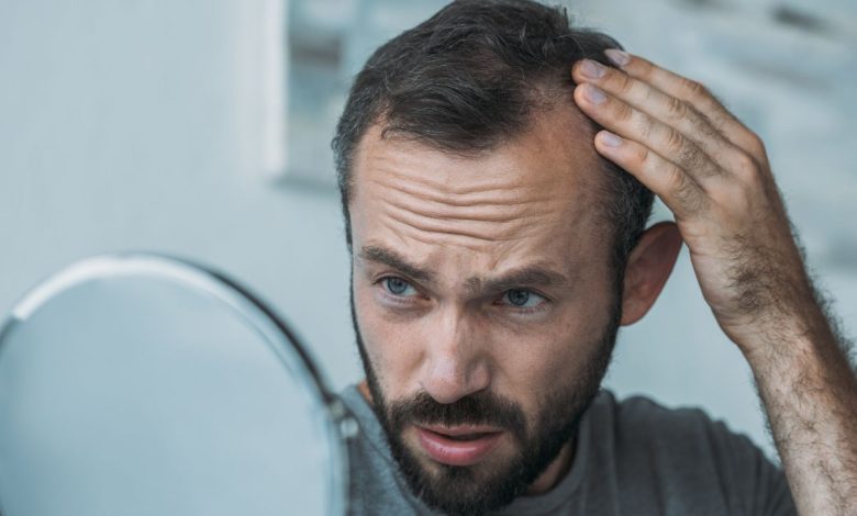 Hair Loss in guy