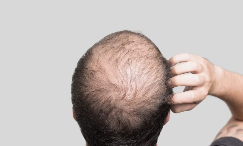 male suffering from Male Pattern Baldness