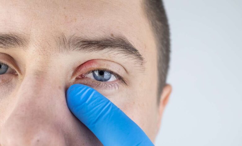 doctor checking patient who has Demodex Blepharitis