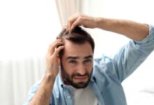 a guy concerned about his Thinning Hair