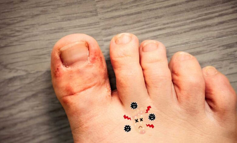 Athlete’s Foot